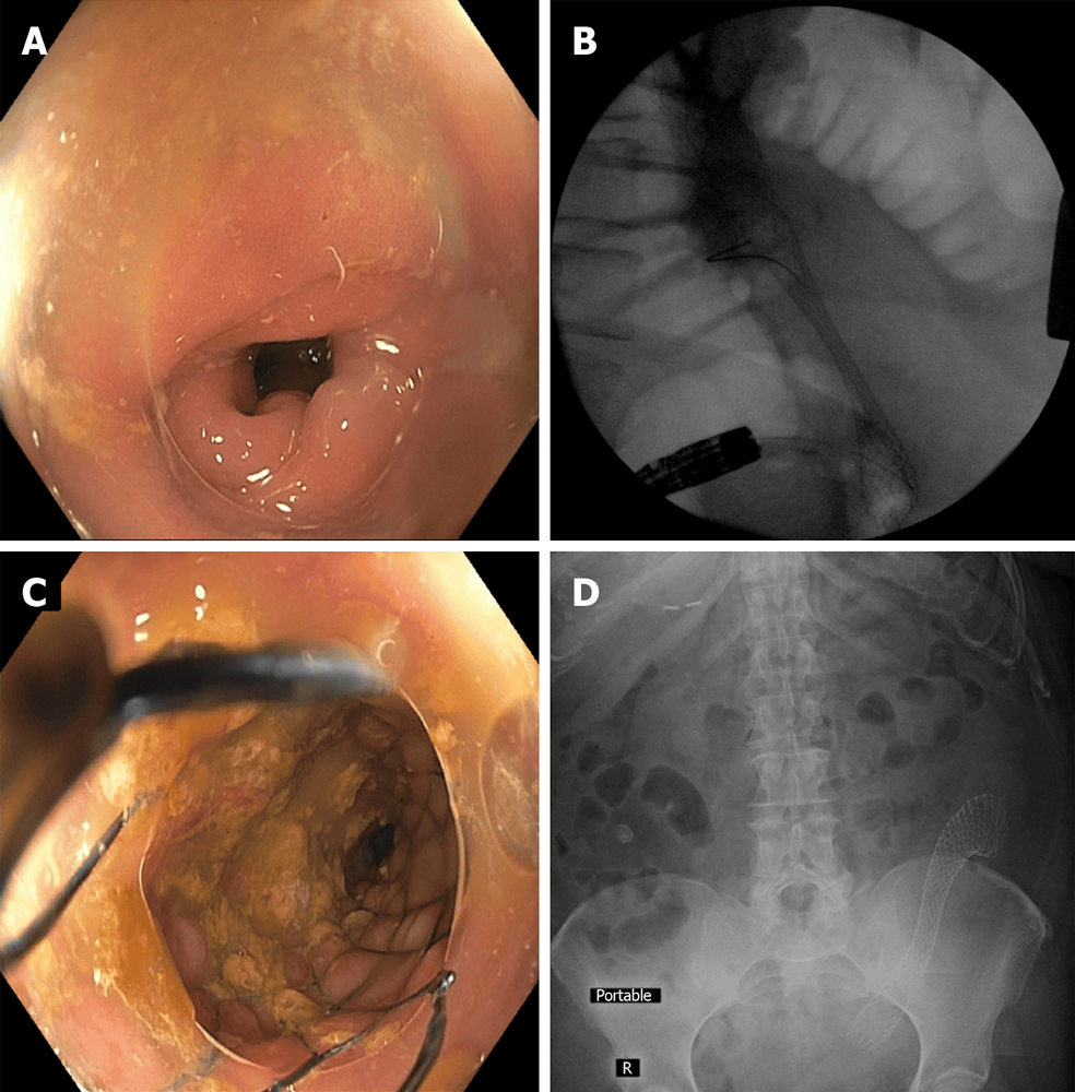 
Đặt stent đại tràng trong trường hợp hẹp đại tràng liên quan đến viêm túi thừa. A: Hẹp đại tràng sigma do viêm túi thừa liên quan đến viêm túi thừa; B: Hình ảnh huỳnh quang của việc triển khai stent kim loại tự giãn nở đại tràng với vòng eo đáng kể; C: Hình ảnh nội soi sau khi đặt stent ; D: Chụp X-quang bụng sau thủ thuật cho thấy stent ở vị trí tốt và có sự giãn nở đáng kể.
