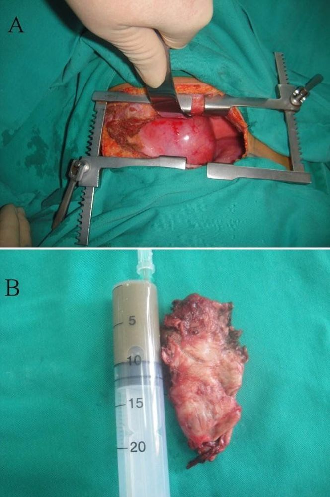 Overview of double esophageal cyst disease