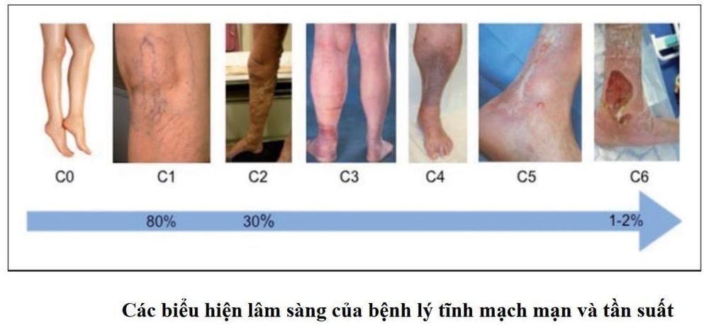 Bệnh giãn tĩnh mạch: Những điều cần biết