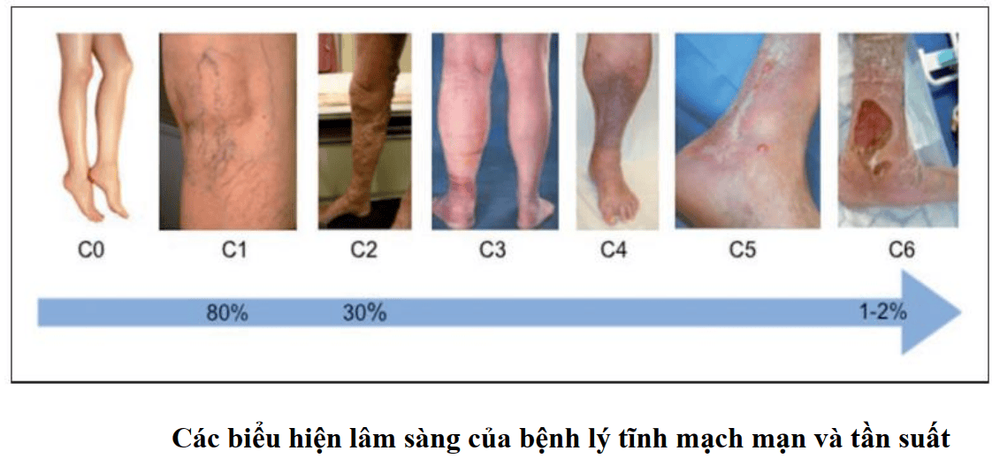 Varicose veins: What you need to know