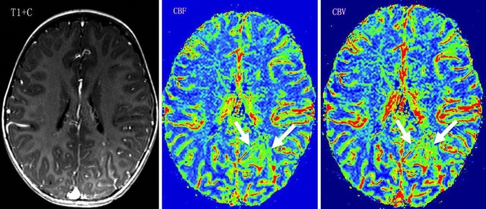 
Chụp CT tưới máu não giúp chẩn đoán đột quỵ
