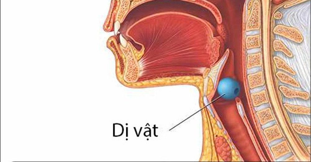 
Nguyên nhân thở khò khè khởi phát cấp tính có thể do dị vật đường thở
