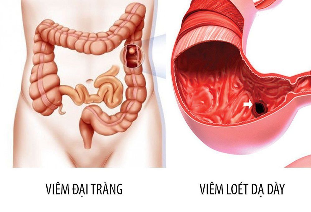 
Tiêu chảy về đêm của bạn có thể là dấu hiệu của một bệnh mãn tính tiềm ẩn
