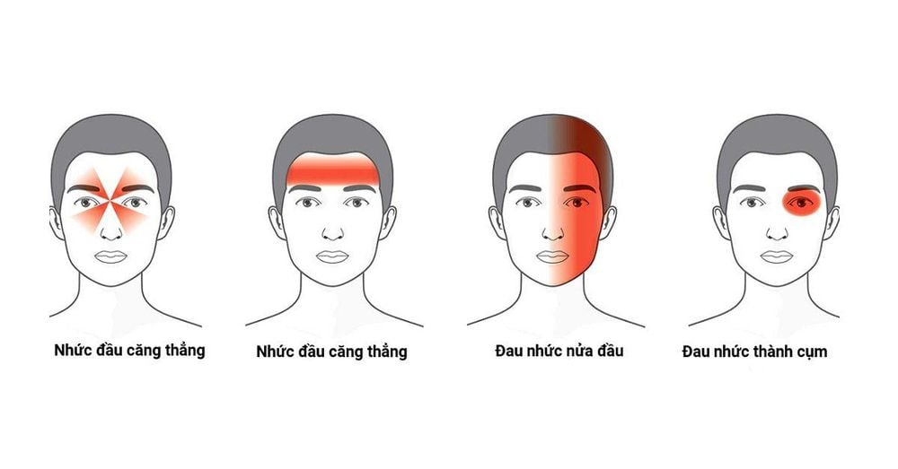 
Một số dạng đau đầu phổ biến hiện nay
