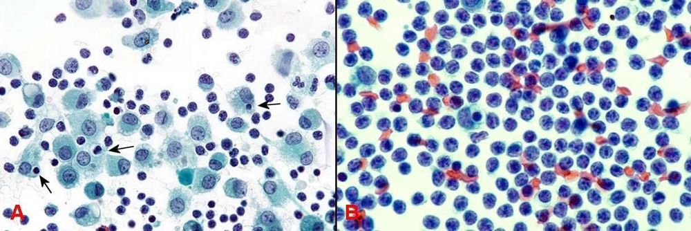 
Hình 4: Các mô bào / Đại thực bào với các không bào có chứa các mảnh vụn nhân của lympho bào chết (mũi tên, A); các lympho bào nhỏ có nhân tròn và rất ít bào tương (B).
