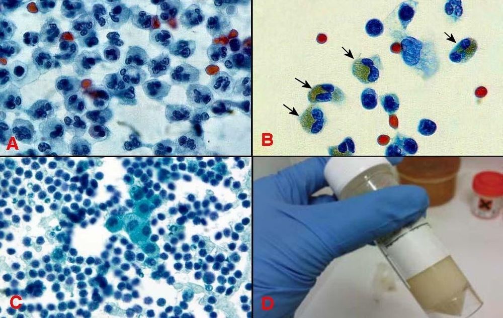 
Hình 5: Tràn dịch mủ (A); tràn dịch bạch cầu ái toan (B); tràn dịch lympho bào (C); tràn dịch dưỡng trấp (D)
