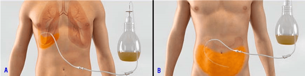 
Hình 2: Chọc dẫn lưu dịch màng phổi (A); chọc dẫn lưu dịch màng bụng (B).
