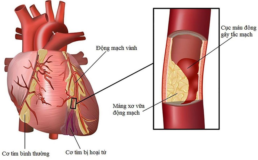 
Trường hợp cơ tim bị hoại tử dẫn đến nồng độ Myoglobin có xu hướng tăng nhanh
