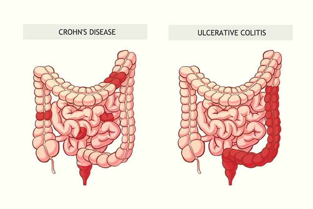 
Bệnh Crohn và viêm loét đại tràng là hai loại IBD
