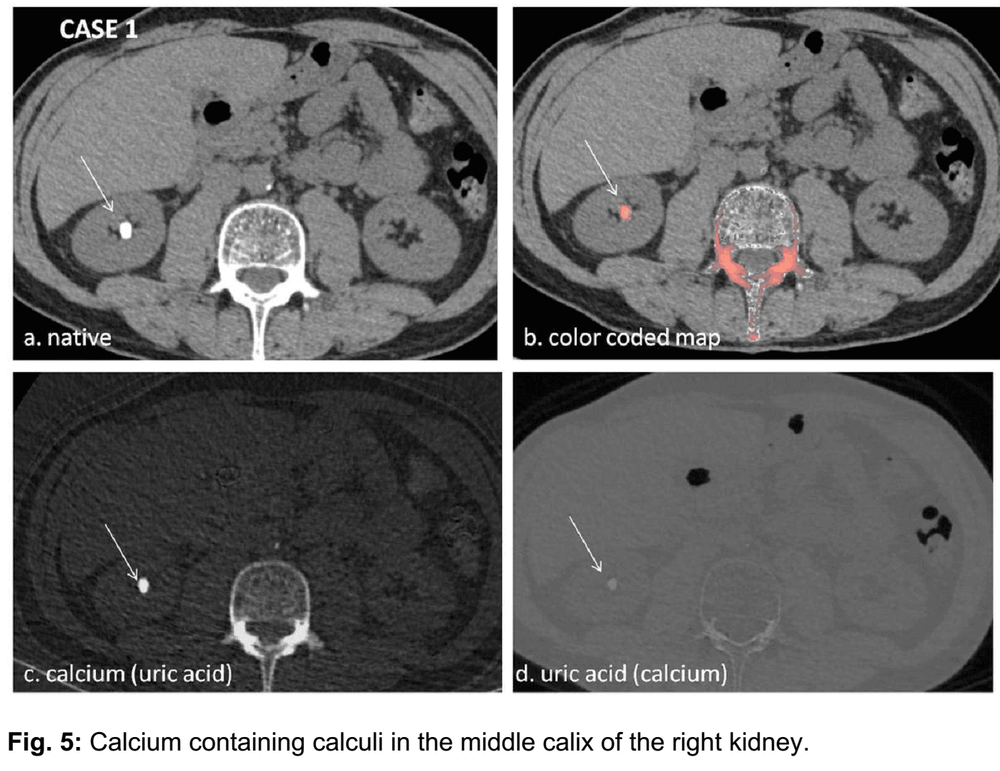 
Hình 2: ca 1. (a) ảnh gốc cho thấy sỏi ở vị trí đài giữa thận phải, (b) tái tạo bản đồ màu canxi, có màu canxi ở vị trí sỏi, (c) ảnh xóa axit uric thấy rõ hình sỏi, (d) ảnh xóa canxi thấy mờ hình sỏi, chứng tỏ thành phần sỏi có canxi
