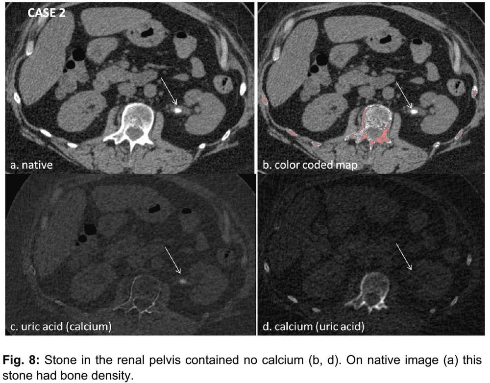 
Hình 3: ca 2. (a) ảnh gốc cho thấy sỏi ở vị trí chỗ nối bể thận – niệu quản trái, (b) tái tạo bản đồ màu canxi, không thấy phủ màu canxi ở sỏi, (c) ảnh xóa canxi thấy còn tồn tại sỏi, (d) ảnh xóa axit uric thấy mất hình sỏi, chứng tỏ thành phần sỏi là axit uric
