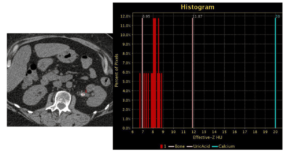 
Hình 5: (ca 2): Hình phải: ảnh gốc với ROI đo số nguyên tử hiệu dụng Z. Hình trái: ảnh phổ cho thấy Z trung bình của sỏi có giá trị từ 6.9 – 9 chỉ ra rằng thành phần của sỏi có axit uric

