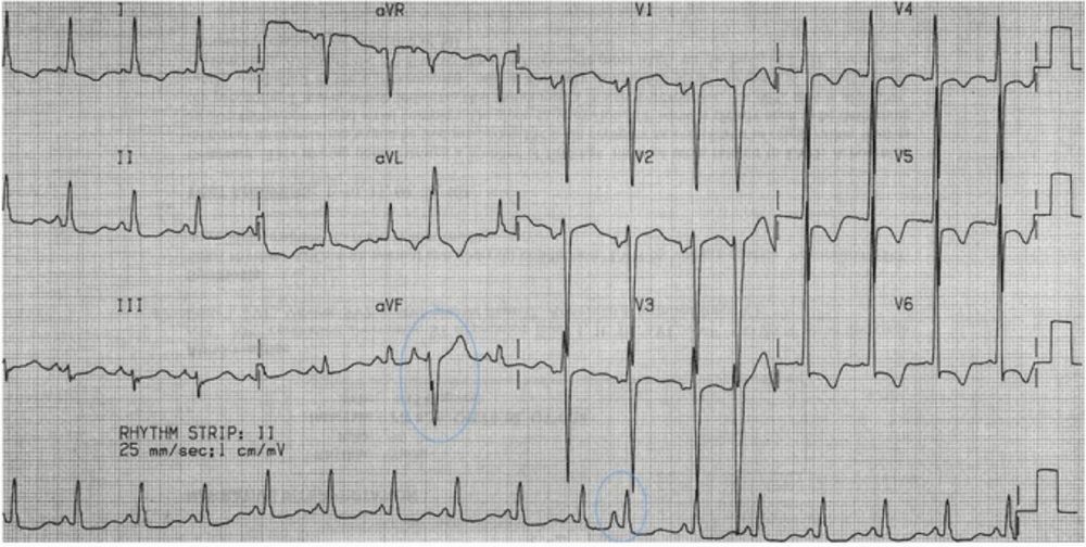 
Hình ảnh ngoại tâm thu nhĩ (PAC) dị thường, nhìn thấy tốt nhất trong aVL và aVF (vòng tròn).
