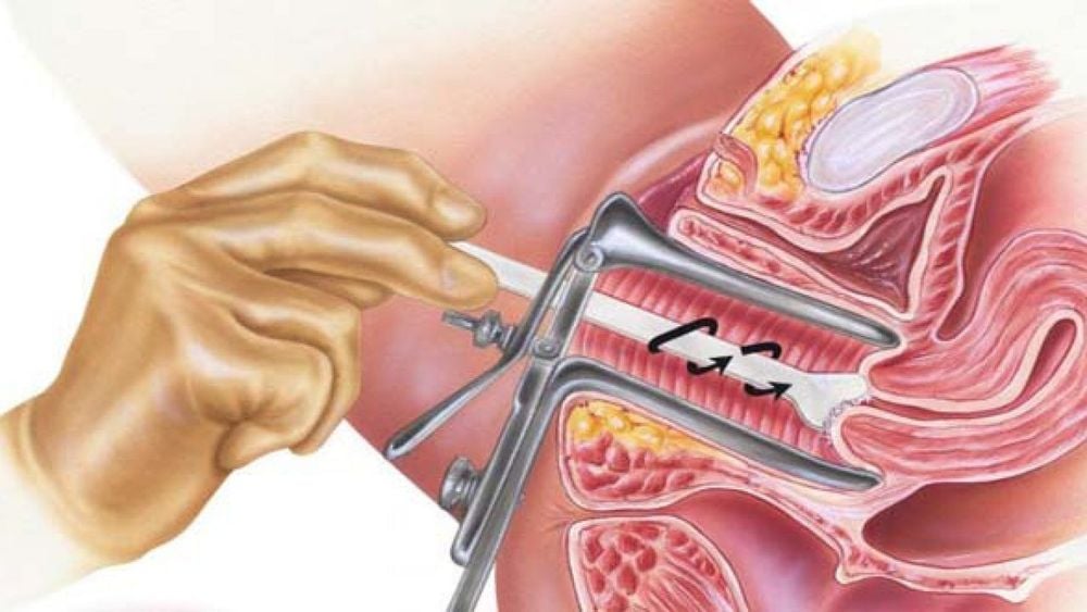 
Xét nghiệm HPV và xét nghiệm Pap là hai xét nghiệm được dùng phổ biến để tầm soát ung thư cổ tử cung
