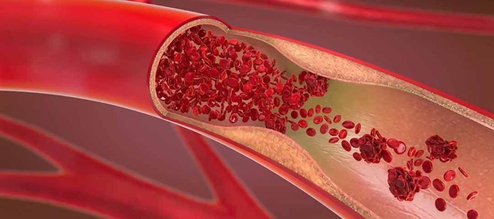 
Bệnh nhân huyết khối tĩnh mạch có thể được chỉ định dùng thuốc kháng đông máu Warfarin
