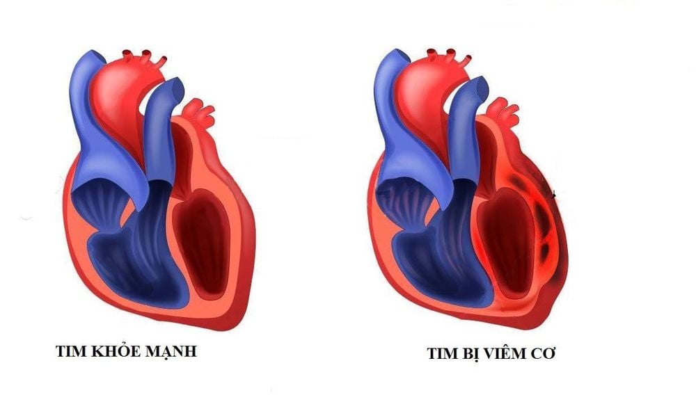 
Người trẻ từ 20 đến 40 tuổi có nguy cơ cao bị bệnh viêm cơ tim
