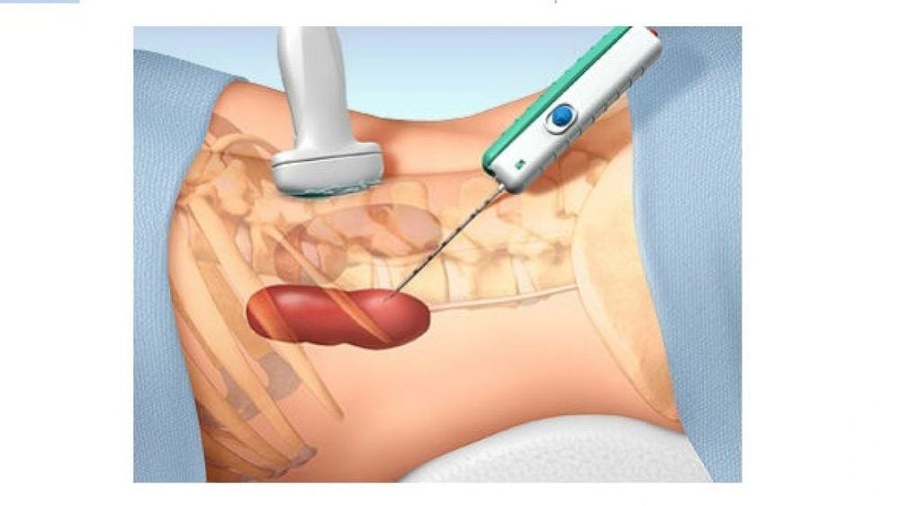 
Quá trình chọc hút nang thận phụ thuộc lớn vào tay nghề, kỹ thuật của bác sĩ
