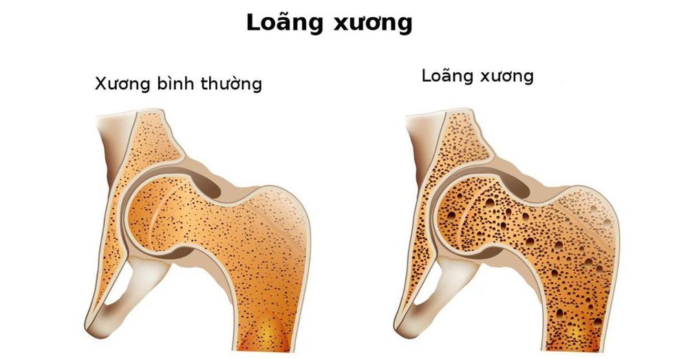 
Loãng xương khiến khả năng vận động suy giảm
