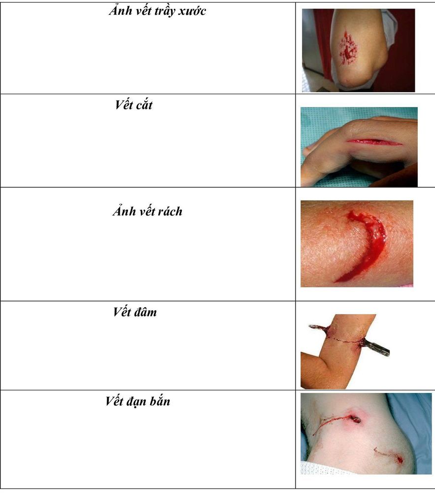 Wound first aid: What you need to know