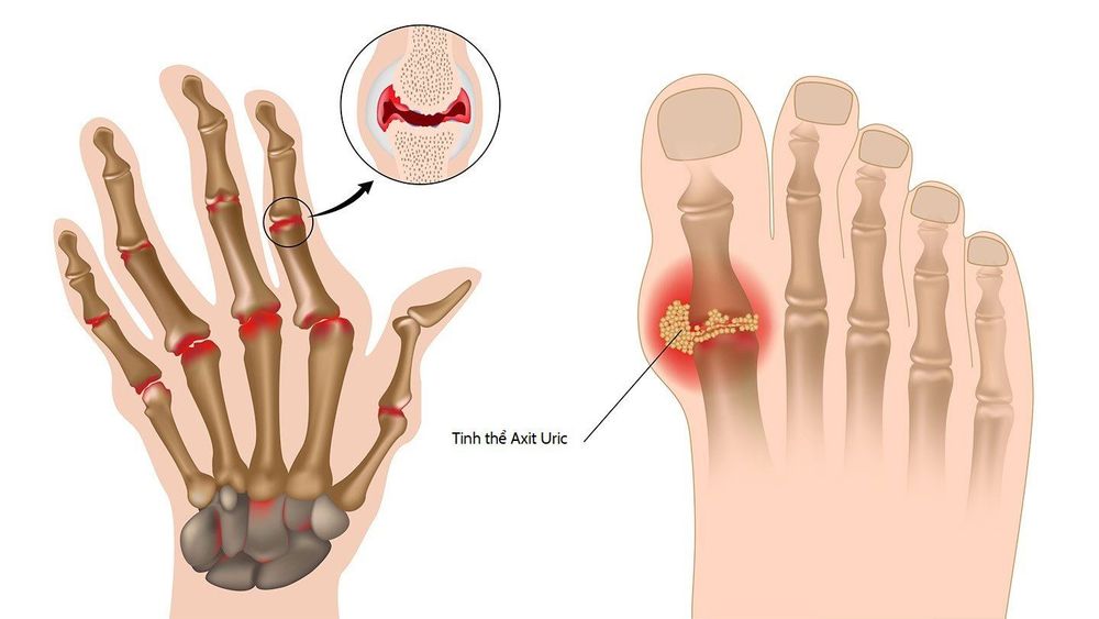 
Những người bị bệnh gout thường chịu các cơn đau dữ dội, thường là ở ngón chân cái, mắt cá chân hoặc đầu gối
