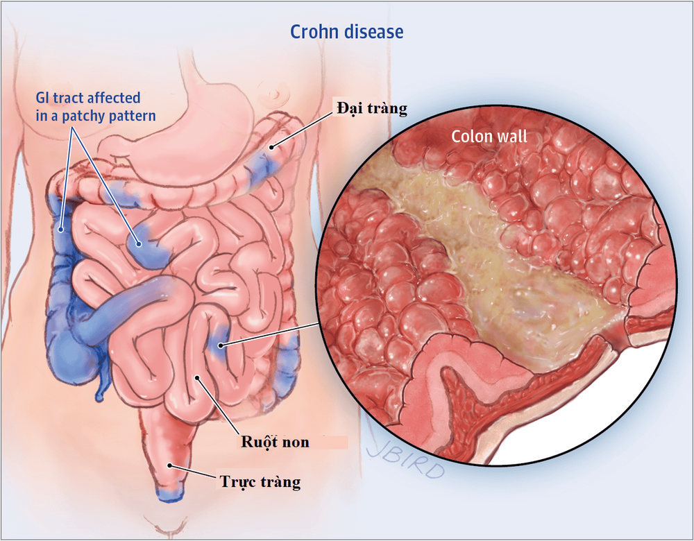 
Bệnh Crohn là một trong các bệnh cơ bản của bệnh amyloidosis AA
