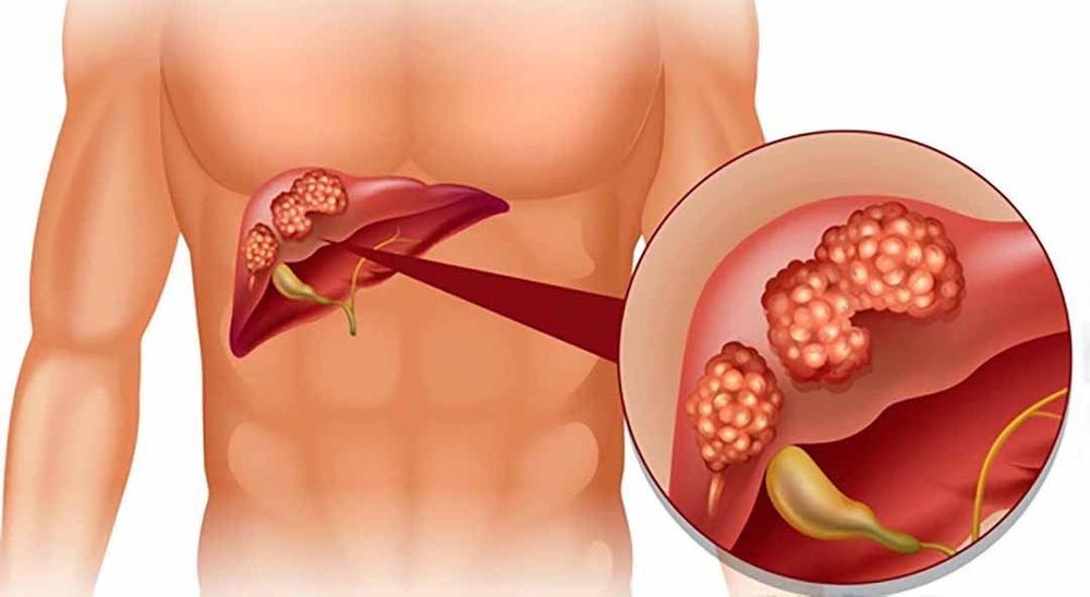 
Cây bùng bục có tác dụng chữa bệnh viêm gan mạn tính
