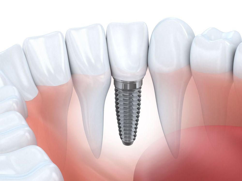 
Bước đầu tiên để làm răng giả implant hay răng nhựa đó là lấy dấu răng miệng.
