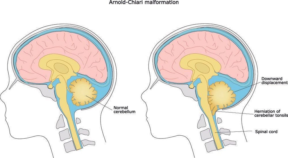 
Các hội chứng Arnold Chiari sẽ có những biểu hiện và mức độ nguy hiểm khác nhau.
