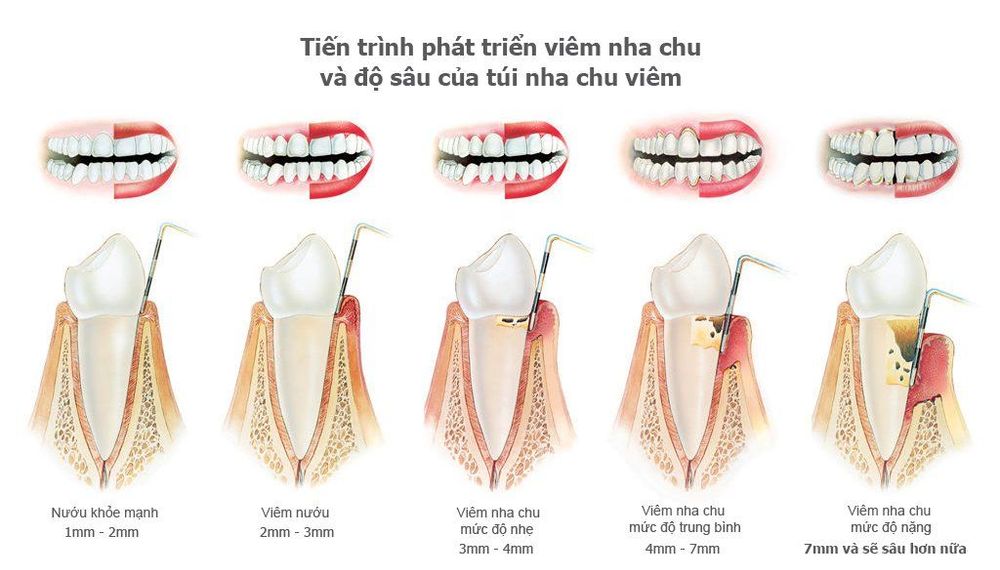 
Bệnh nhân suy thận bị viêm nha chu nếu phòng bệnh tốt hơn có giúp cải thiện tình trạng.
