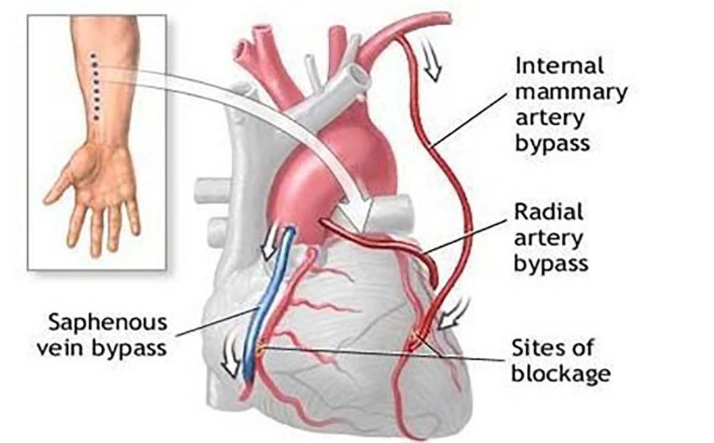 
Phẫu thuật bắc cầu là một trong những phương pháp thông mạch vành.
