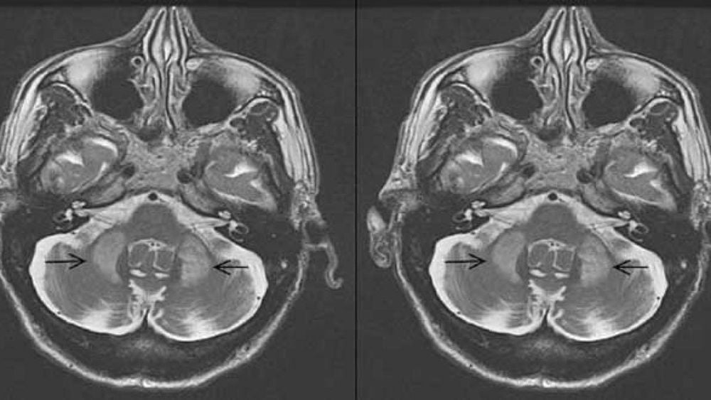 
Chụp MRI não là một kỹ thuật giúp chẩn đoán teo đa hệ thống
