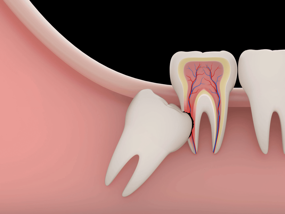 
Một số trường hợp người bệnh cần được chỉ định nhổ răng 8
