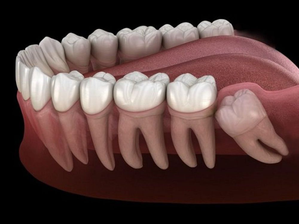 
Trường hợp răng khôn mọc ngầm cần được nhổ sớm
