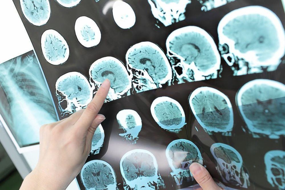 
Bệnh mạch máu tinh bột có tên tiếng anh là amyloid angiopathy
