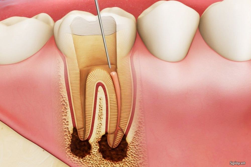 
Với công nghệ nha khoa hiện nay thì lấy tủy răng không đau là hoàn toàn có thể
