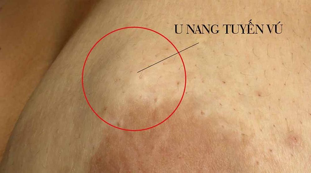 Vú nhạy cảm: Nguyên nhân và triệu chứng