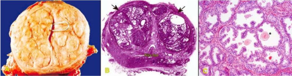 
Giải phẫu bệnh tuyến tiền liệt lành tính tuyến tiền liệt tăng sản dạng cục (Các cục tăng sản tập trung ở vùng trong, chèn ép niệu đạo (A,B); tuyến tăng sản tạo nhú và bọc, trong lòng có chứa thể amylacea (*); tăng sản mô đệm sợi-cơ trơn giữa các tuyến (C))

