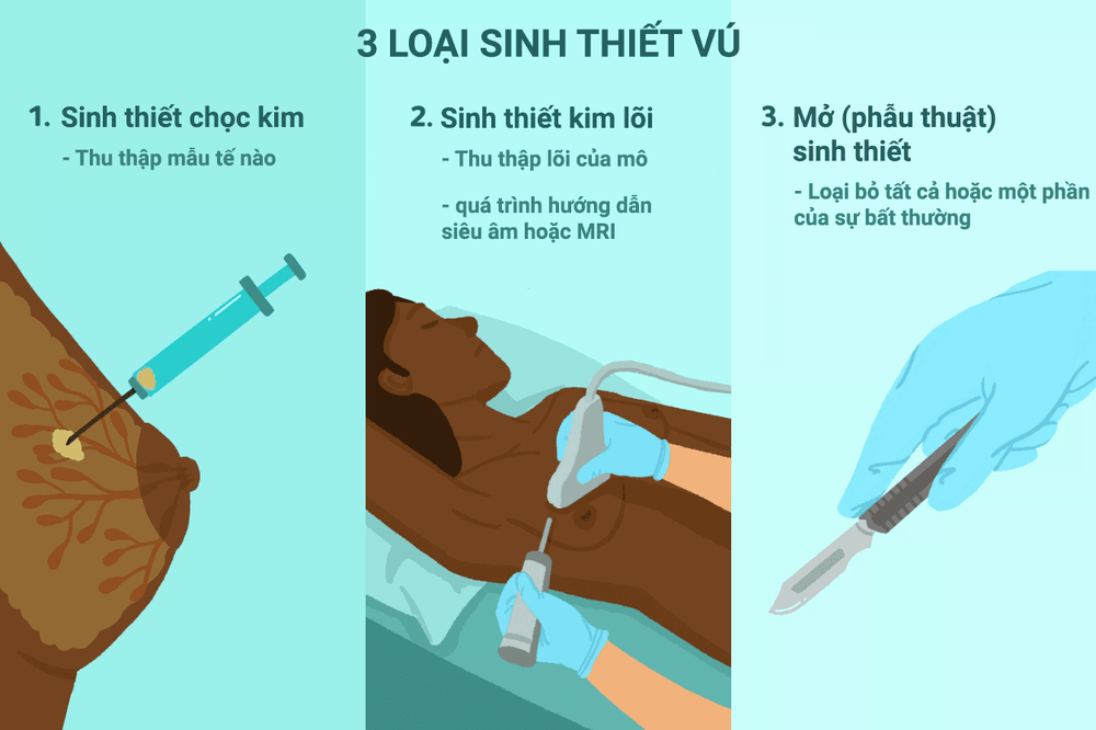 
3 loại sinh thiết vú cơ bản hiện nay
