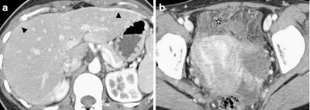 
Bệnh nhân nữ 26 tuổi đau hạ sườn phải và sốt nhẹ, nhập khoa cấp cứu. (a) CT thì động mạch cho thấy viêm bao gan lan tỏa (đầu mũi tên) bắt thuốc dọc phần trước ngoài gan. (b) CT vùng chậu cho thấy thâm nhiễm mỡ phúc mạc và phần trước khoang chậu (dấu sao), phù hợp với viêm nhiễm vùng chậu.
