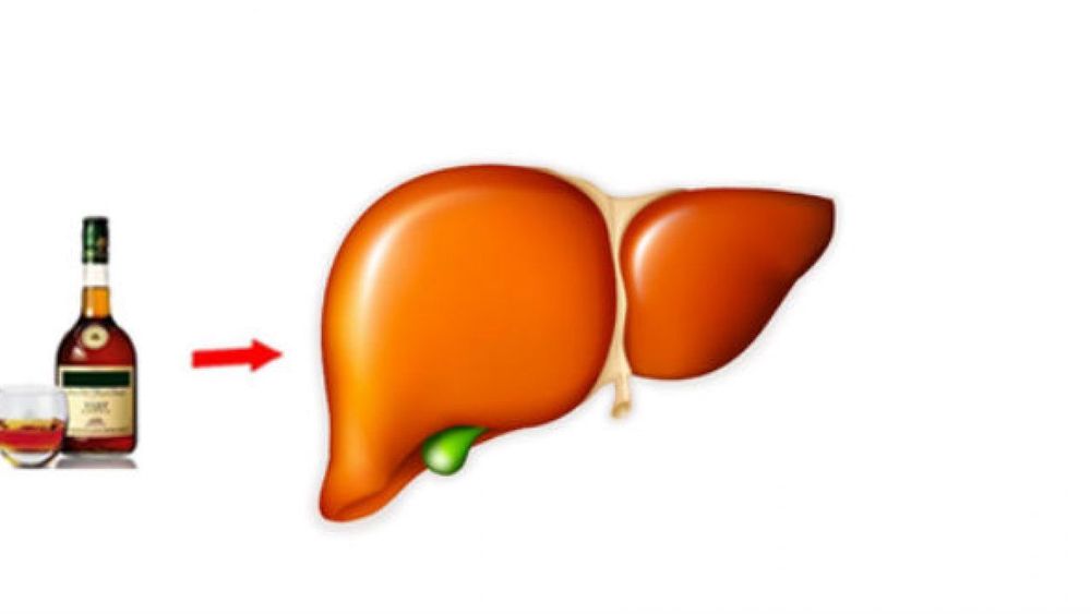
Bệnh gan do rượu ban đầu được đặc trưng bởi gan nhiễm mỡ, sau đó có thể phát triển thành viêm gan do rượu, xơ hóa gan và xơ gan.
