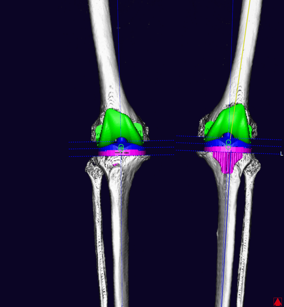 
Hình ảnh: Kỹ thuật dựng hình 3D ứng dụng trong phẫu thuật thay khớp gối
