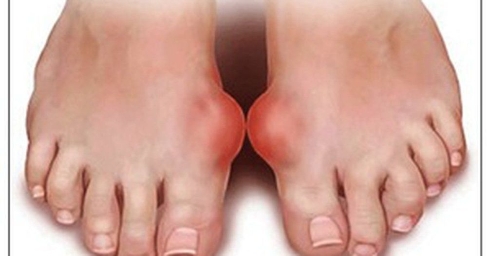 
Bệnh gout cũng có thể là nguyên nhân gây ra các bệnh về viêm khớp cổ chân
