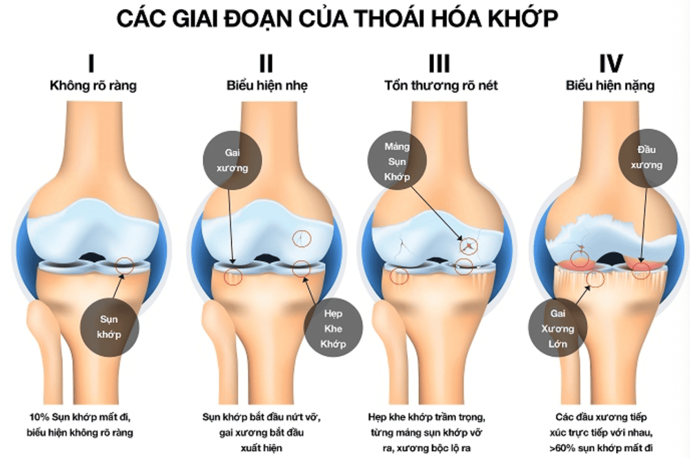 Bốn giai đoạn của thoái hoá khớp  