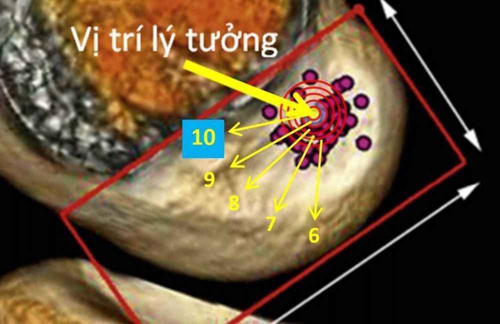 
Hình 1: Minh họa vị trí đặt đường hầm xương đùi trong 50 lần của một phẫu thuật viên lão làng khi chỉ dựa vào kinh nghiệm (Theo tác giả Harlem, trong cuốn sách “The Anterior Cruciate Ligament” (Dây chằng chéo trước), xuất bản 2018)
