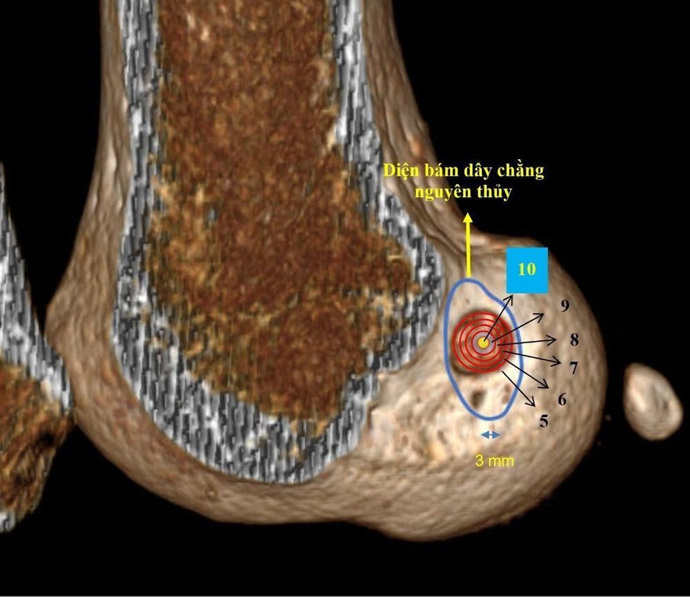 
Hình 2: Minh họa vị trí khoan đường hầm đùi chính xác ở một bệnh nhân đã được phẫu thuật tại Trung tâm Chấn thương chỉnh hình & Y học thể thao Vinmec (tâm đường hầm ở đúng hồng tâm trên bia bắn tưởng tượng)
