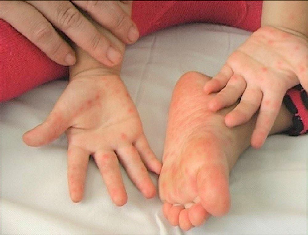Tay chân miệng là bệnh thường gặp ở trẻ vào mùa đông