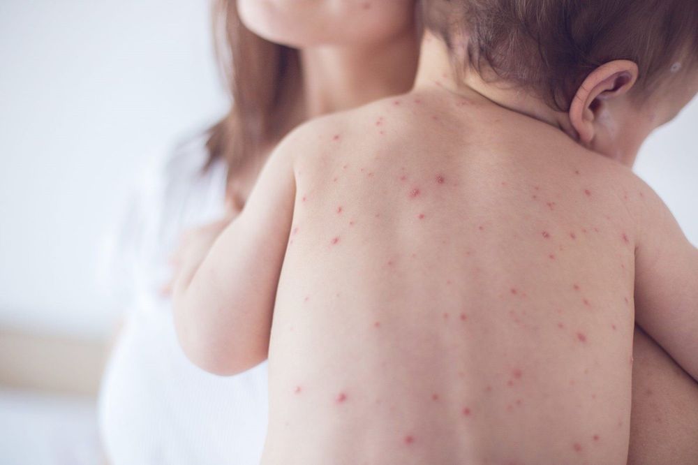Diễn biến bệnh sốt xuất huyết ở trẻ em trải qua ba giai đoạn