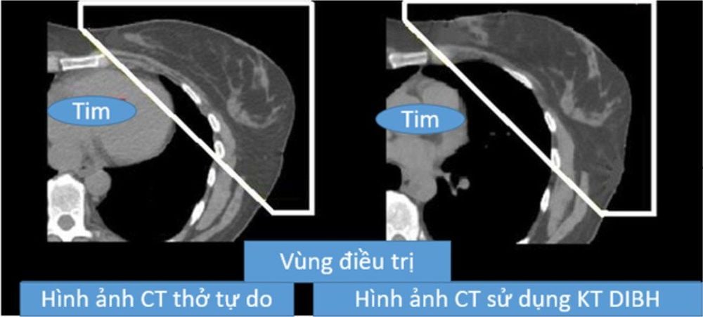 
Tim di chuyển khỏi khu vực điều trị khi phổi chứa đầy không khí.
