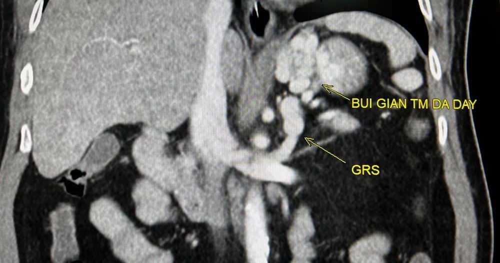 
Hình 5. Hình chụp CLVT cho thấy búi giãn tĩnh mạch dạ dày có shunt vị - thận (GRS)
