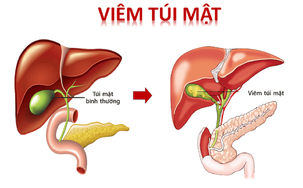 
Hình ảnh mô phỏng tình trạng viêm túi mật
